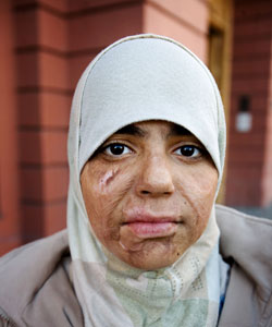 Ayat skadades av en klusterbomb. Foto: Magnus Fröderberg